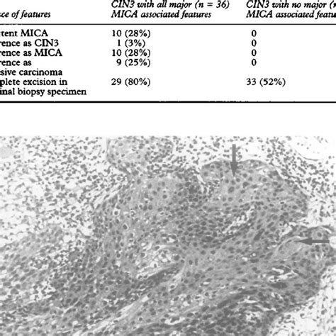 CIN3 lesion. Note intralesional squamous differentiation and early ...