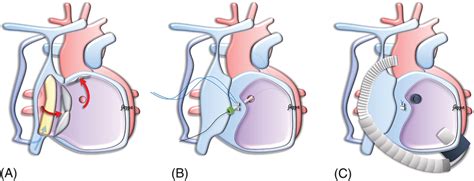 Hybrid Ventricular Septal Defect Closure And Ventricular Assist Device