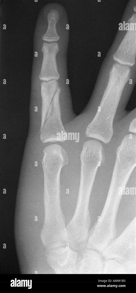 X Ray Oblique Fracture Of Proximal Phalanx 5th Finger Stock Photo Alamy