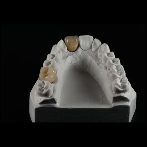 China PFM Ceramic Crowns Manufacturers Suppliers Factory - Low Price - DIGITAL DENTAL LAB