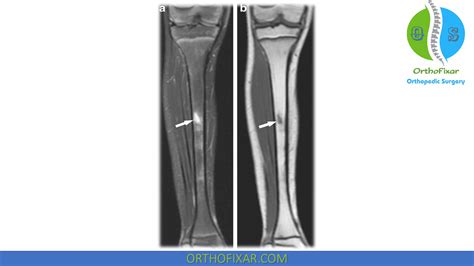 Tibial Stress Fracture Orthofixar 2025