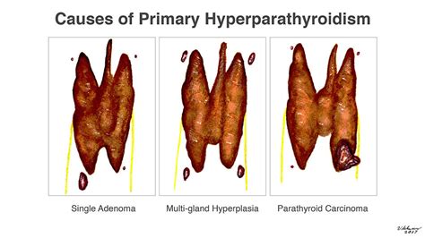 Parathyroid Tumors Miami Cancer Institute