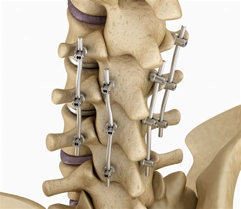 Discover Expert Revision Spinal Fusion Surgery in Delhi by Dr. V. Anand ...