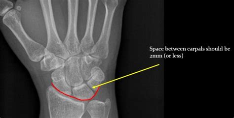 Lunate Dislocation – The Emergency Physio