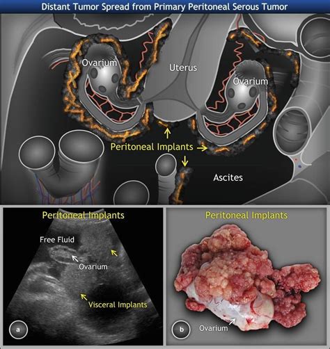 Pin On Ovarian Tumors