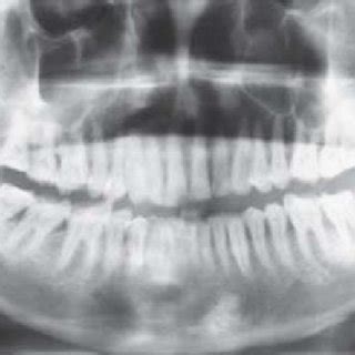 Panoramic Radiograph Showing Well Defined Multilocular Radiolucent Area