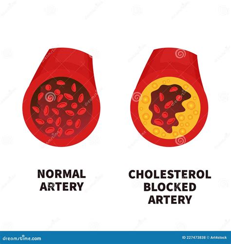 Normal And Narrowed Artery Cross Section Illustration Stock