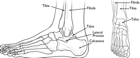 OCD Lesions of Talus