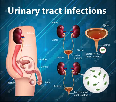 Premium Vector Informative Illustration Of Urinary Tract Infections