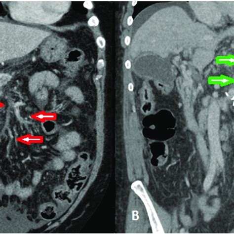 Classification Of Portal Vein Thrombosis By Yerdel Et Al Adapted From