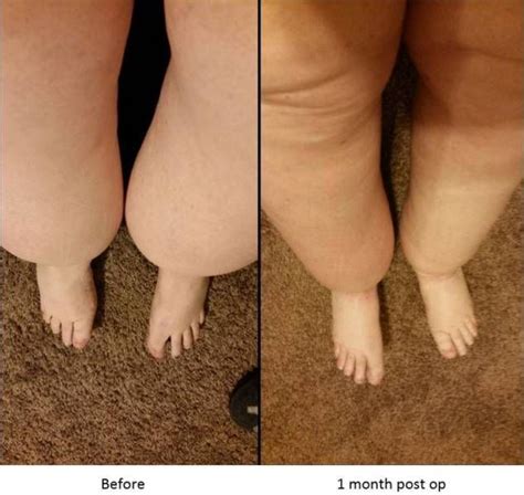 Pin By April On Lymphedema Lipedema Lipedema Disorders Lymphedema