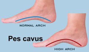 Pes cavus foot definition, causes, symptoms, diagnosis & treatment