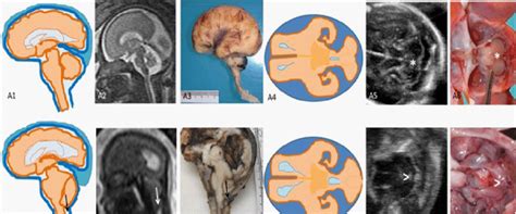 Arnold Chiari Malformation A Schematic Representation A1 A4