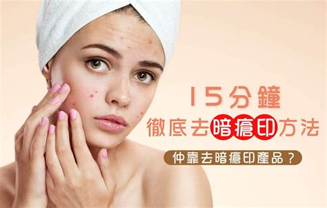 【去暗瘡印懶人包】15分鐘去暗瘡印方法，消炎消腫不留凹凸洞 Beauty Place