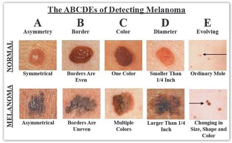 Malignant Melanoma Abcde