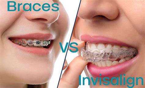 Invisalign Vs Braces The Pros And Cons Of Each Gibbs Orthodontic