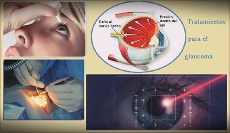 Tratamiento Para El Glaucoma