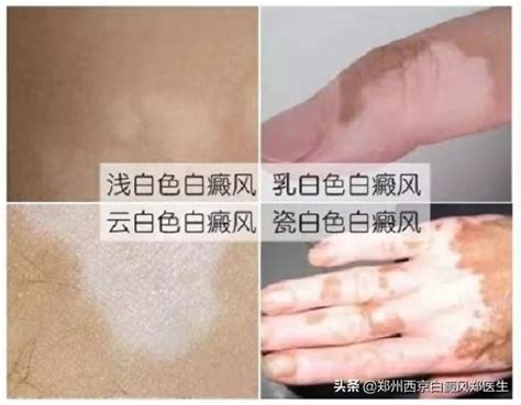 白癜風發病的規律，你都知道嗎？這4點要了解 每日頭條