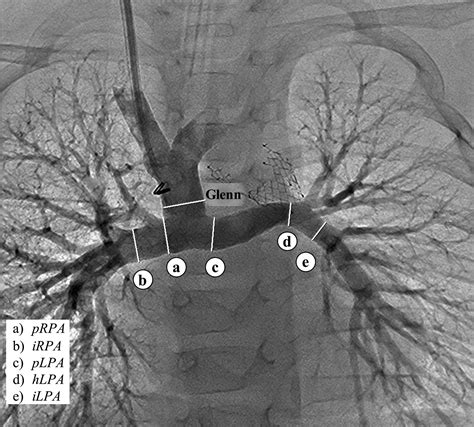 Preemptive Stenting Of The Left Pulmonary Artery During Comprehensive