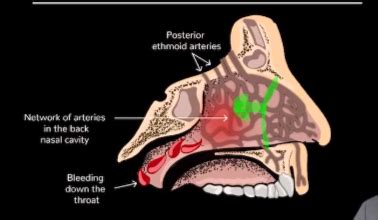 EPISTAXIS Causes And Management PrepLadder