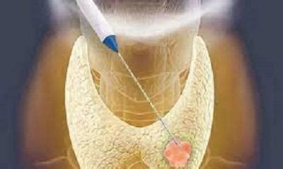 Radiofrequency Ablation (RFA) of Thyroid Nodules | Interventional Radiology located in Denver ...