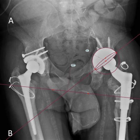 Pdf Outcomes Of An Imageless Computer Assisted Revision Total Hip