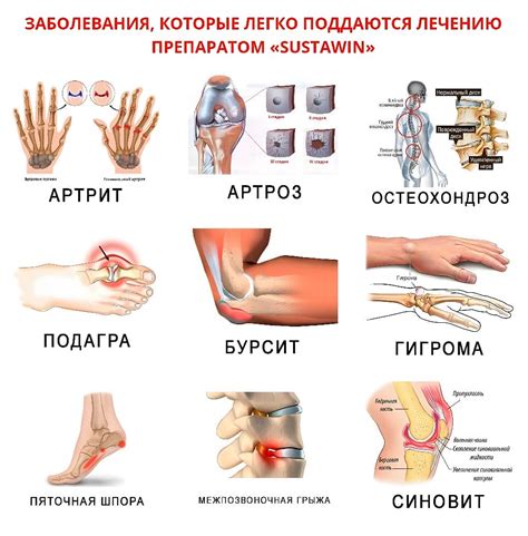 Sustawin (Суставин) капсулы для суставов (11 фото): купить, цена ...