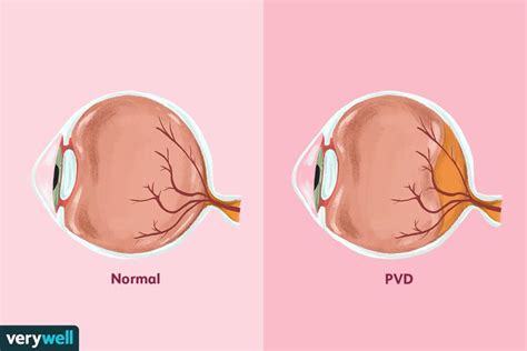 Posterior Vitreous Detachment PVD Symptoms And Treatment