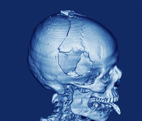 Skull Fracture Queenhrom