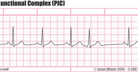 ECG Educator Blog : Premature Junctional Complex (PJC)