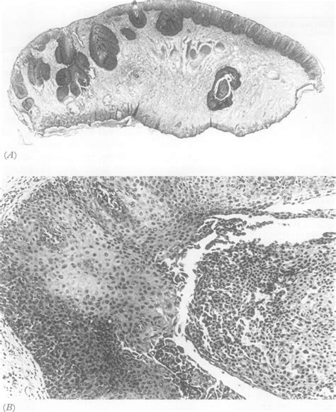 Cin3 Involving And Expanding Endocervical Crypt A Note Intralesional Download Scientific