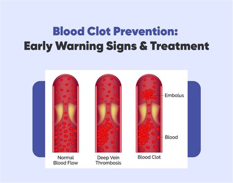 Blood Clot Prevention: Early Warning Signs & Treatment