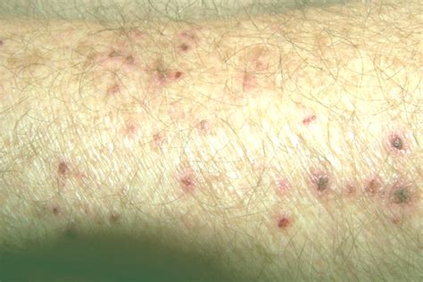 Morgellons Disease - Pictures, Symptoms, Treatment, Causes