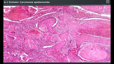 MicroscopÍa 30 Carcinoma Epidermoide Youtube