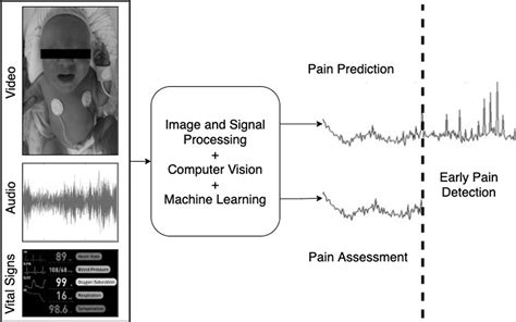 Future Roles Of Artificial Intelligence In Early Pain Management Of