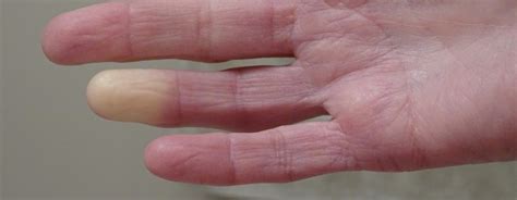 Raynaud Syndrom Symptome Ursachen Behandlung Fernarzt