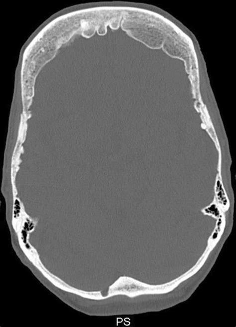 Diffuse Idiopathic Skeletal Hyperostosis Hyperostosis Frontalis