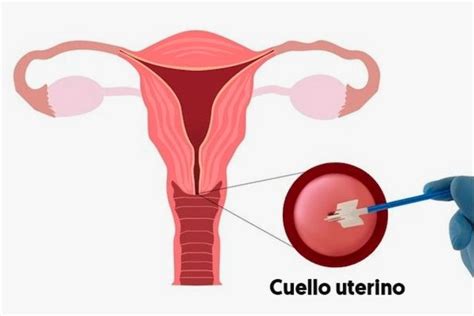 Aldia Qu Es El Examen De Papanicolaou La Prueba De Off
