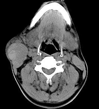 Parotid Pleomorphic Adenoma Radiology Case Radiopaedia Org