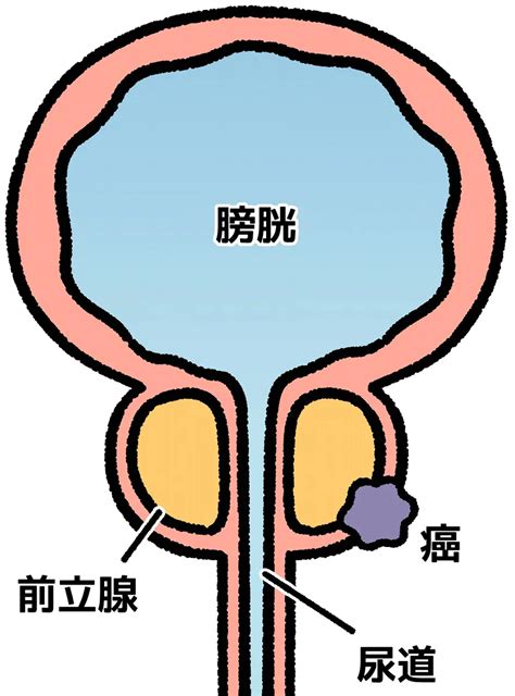 前立腺がんの症状チェック｜原因・治療法｜小田泌尿器科