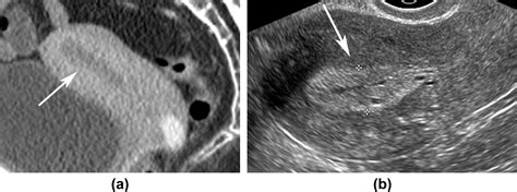 Performance Of Multidetector Ct In The Evaluation Of The Endometrium