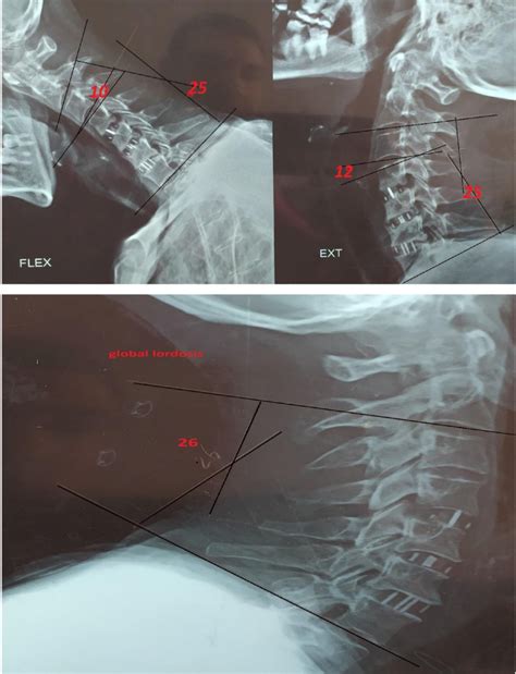 6 Months Postoperative X Ray Cervical Spine Flexion Extension And Download Scientific Diagram