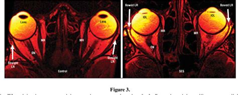 Inferior rectus muscle structure | Semantic Scholar