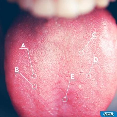 Cancer Spots On Tongue