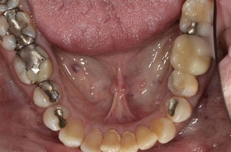 Amalgam Sanierung mit Keramik und Komposit Dr med dent Lorenz Flückiger