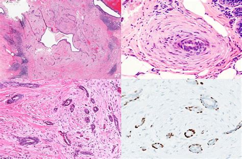 Low‐grade Adenosquamous Carcinoma Of The Breast A Clinical