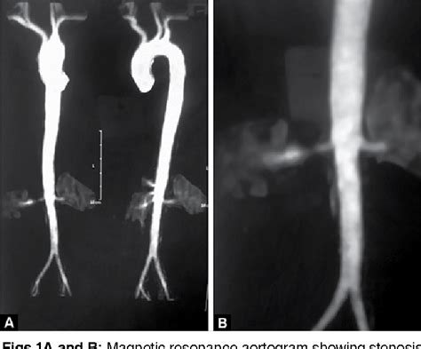 Figure 1 From Intimal Fibromuscular Dysplasia Of Renal Artery A Rare Case Of Hypertension