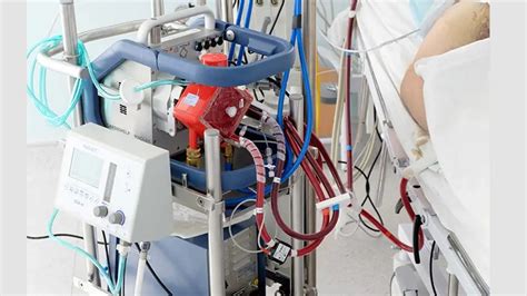 Ecmo Therapy Helps To Recover Lung Function In A Majority Of Patients