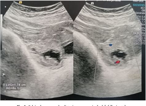 Figure 2 From Diagnosis And Management Of A Spontaneous Heterotopic