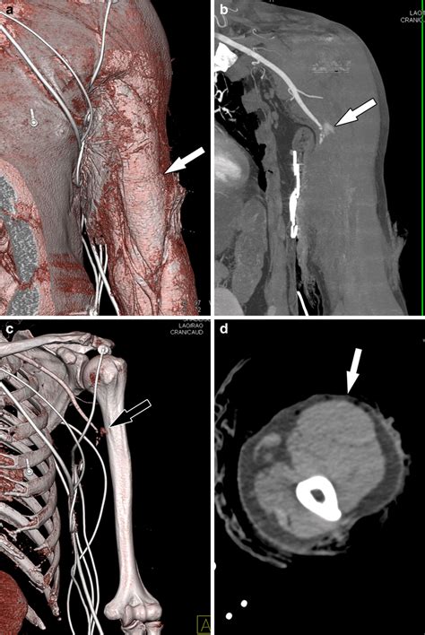 Transection Mdct Angiogram Of The Left Upper Extremity In Arterial